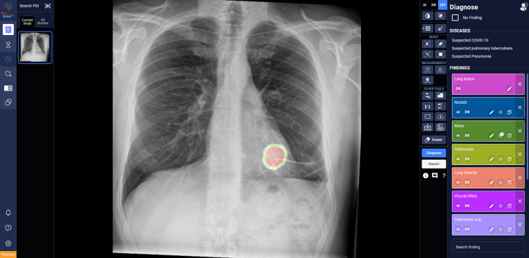 Screenshot of a chest x-ray and the AI-based app developed by Steven Truong's company.